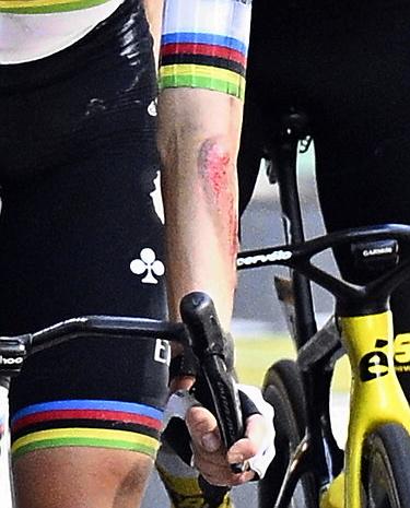 The injured arm of Slovenian Tadej Pogacar of UAE Team Emirates pictured at the finish of stage 11 of the 2025 Tour de France cycling, from and to Toulouse (154km), on Wednesday 16 July 2025 in France. The 112th edition of the Tour de France starts on Saturday 5 July in Lille, France, and will finish in Paris, France on the 27th of July. BELGA PHOTO JASPER JACOBS